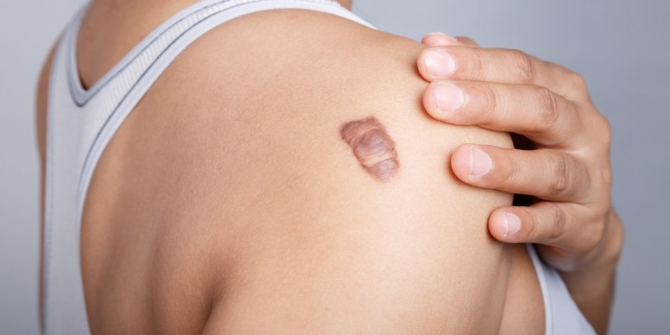 service images keloid scars